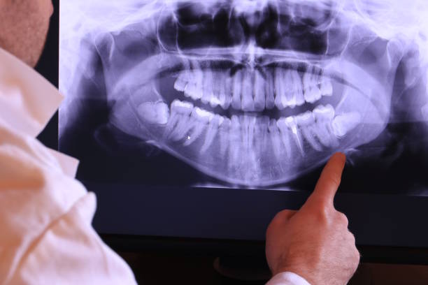 Best Emergency Dental Extractions in Martinsvle, IL